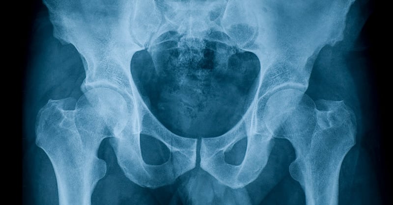 X-ray image of pelvis